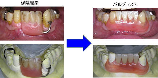 保険義歯とノンメタルクラスプ義歯