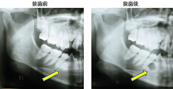 右下第一小臼歯が水平に埋伏している症例