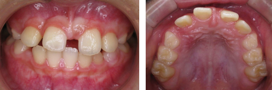 上顎正中過剰埋伏歯があるために、前歯が離開