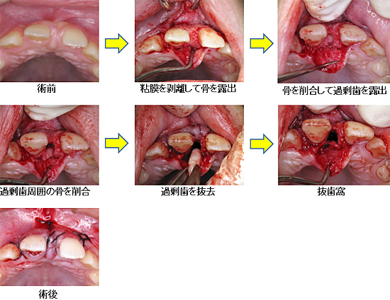 上顎正中過剰埋伏歯の手術