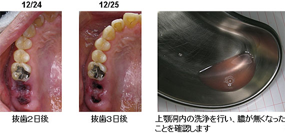 上顎洞炎の治療例２−５