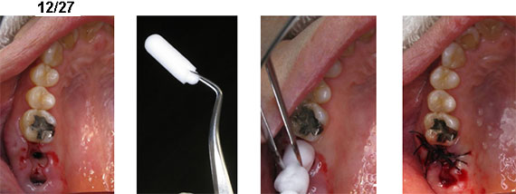 上顎洞炎の治療例２−６