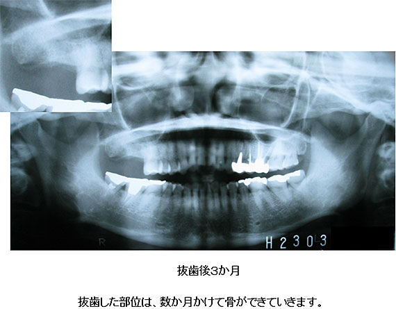 上顎洞炎の治療例２−９